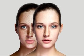 Descubre los tratamientos para eliminar las manchas de la piel