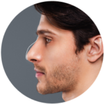 Postoperatorio de la rinoplastia: tiempo de recuperación, cuidados y resultados finales 4 rinoplastia resultado