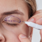 preparación para una blefaroplastia