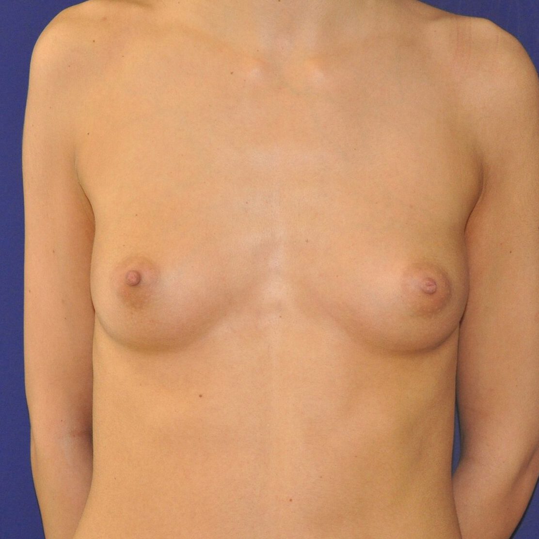 Aumento de pecho antes - vista perfil | Herrero Jover Médicos