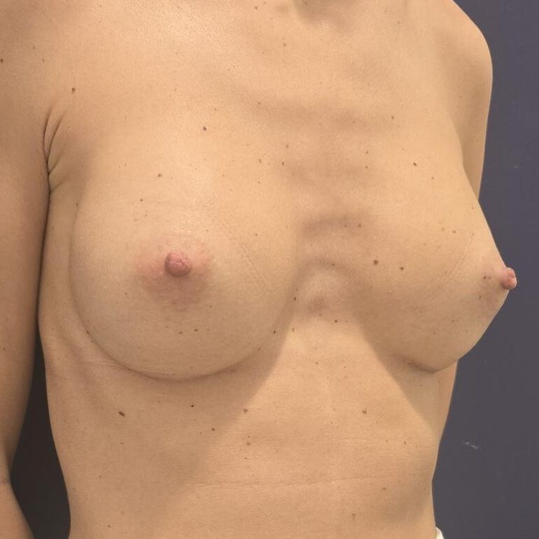 Aumento de pecho después - vista oblicua | Herrero Jover Médicos