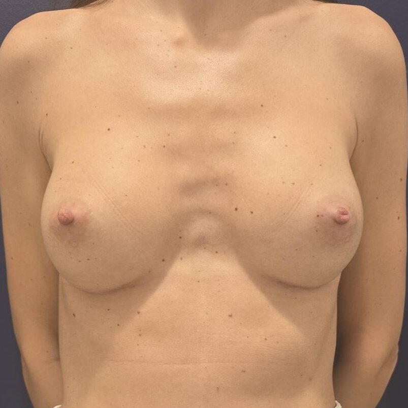 Aumento de pecho después - vista perfil | Herrero Jover Médicos
