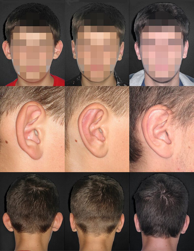 otoplastia. antes y despues