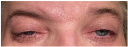 ptosis palpebral
