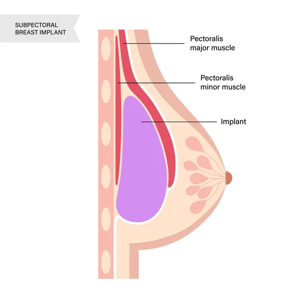 ilustracion medica de corte sagital mamario con implante