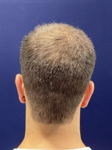 Clínica estética en Barcelona 21 vista coronilla pre tratamiento capilar