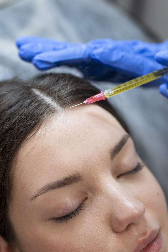 PRP mesoterapia capilar