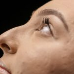 ¿Existe la rinoplastia sin cirugía? La verdad tras el término 4 como mejorar nariz. rinoplastia o rinomodelacion