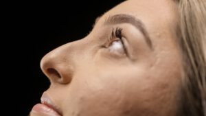 Clínica estética en Barcelona 21 como mejorar nariz. rinoplastia o rinomodelacion