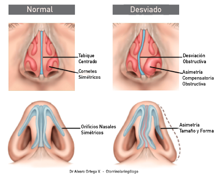 Operación de tabique desviado: Cuándo añadir rinoplastia 1 tabique desviado